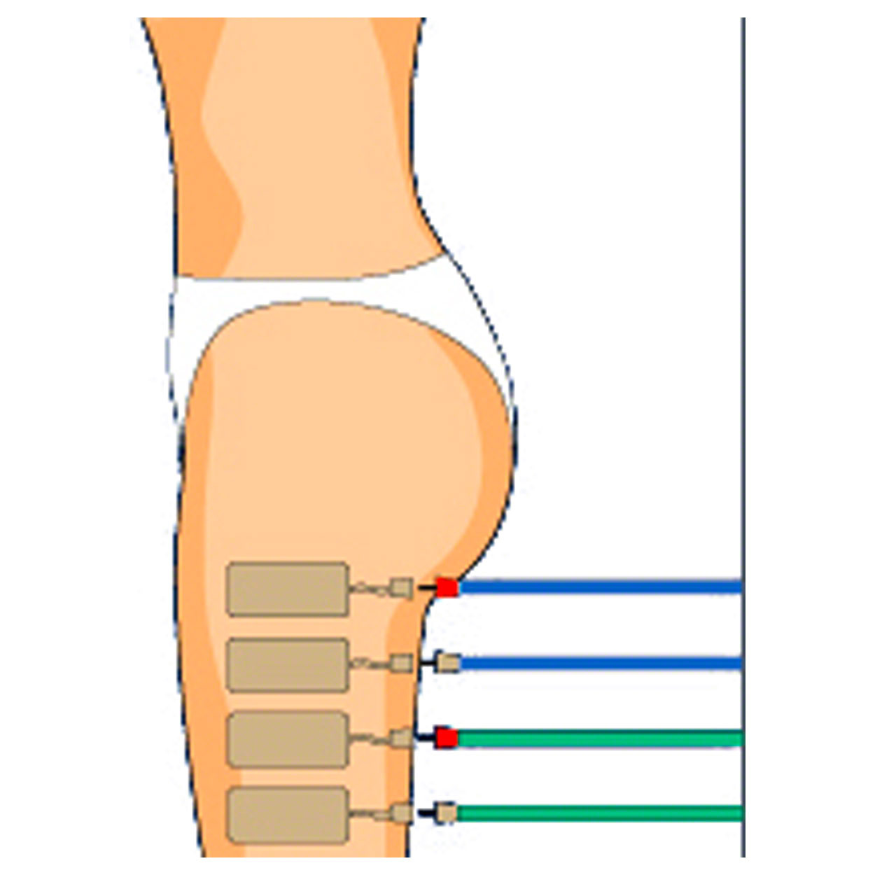 Compex Fils d'électrodes